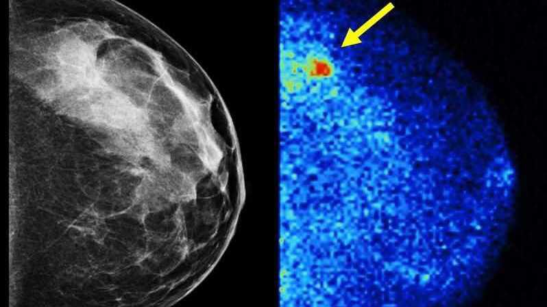 Mammogram vs. molecular breast imaging